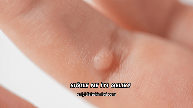 Siğile Ne İyi Gelir?