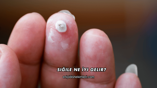 Siğile Ne İyi Gelir?