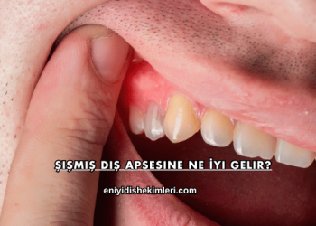 Şişmiş Diş Apsesine Ne İyi Gelir?