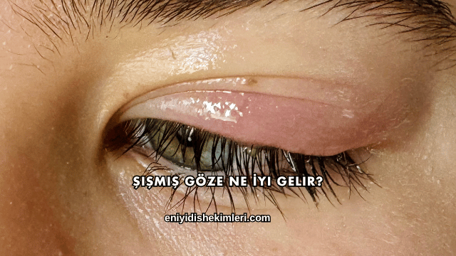 Şişmiş Göze Ne İyi Gelir?