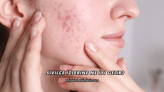 Sivilce İzlerine Ne İyi Gelir?