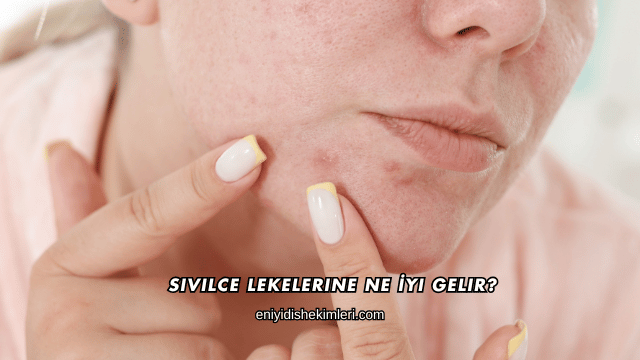 Sivilce Lekelerine Ne İyi Gelir?