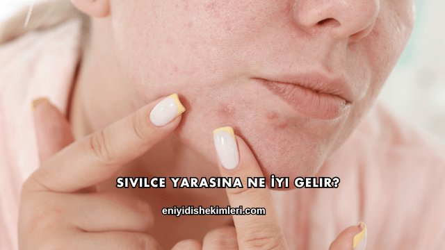 Sivilce Yarasına Ne İyi Gelir?