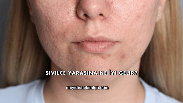 Sivilce Yarasına Ne İyi Gelir?