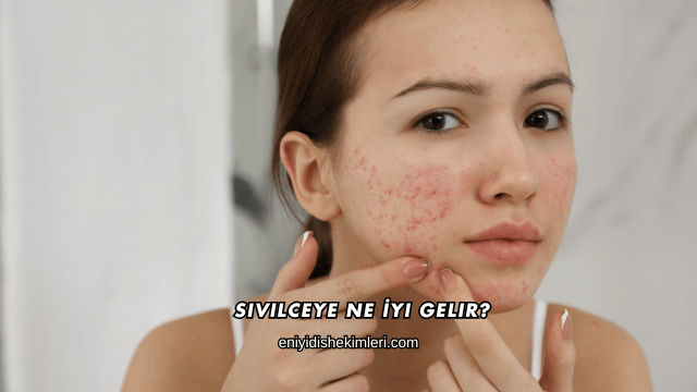 Sivilceye Ne İyi Gelir?