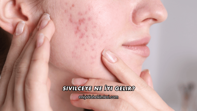 Sivilceye Ne İyi Gelir?