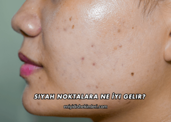 Siyah Noktalara Ne İyi Gelir?