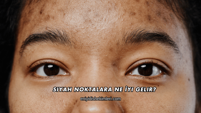 Siyah Noktalara Ne İyi Gelir?