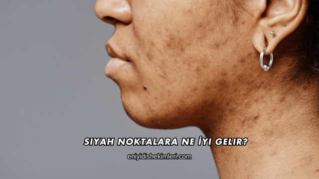 Siyah Noktalara Ne İyi Gelir?