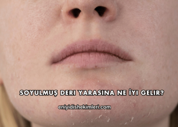 Soyulmuş Deri Yarasına Ne İyi Gelir?
