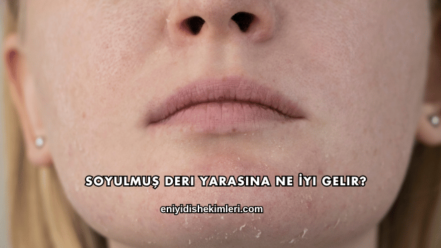 Soyulmuş Deri Yarasına Ne İyi Gelir?