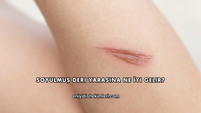 Soyulmuş Deri Yarasına Ne İyi Gelir?