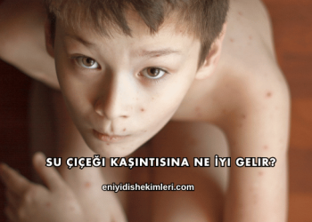 Su Çiçeği Kaşıntısına Ne İyi Gelir?