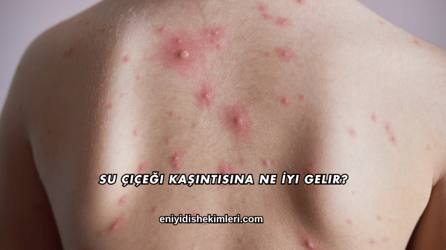 Su Çiçeği Kaşıntısına Ne İyi Gelir?