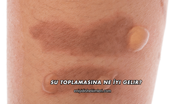 Su Toplamasına Ne İyi Gelir?