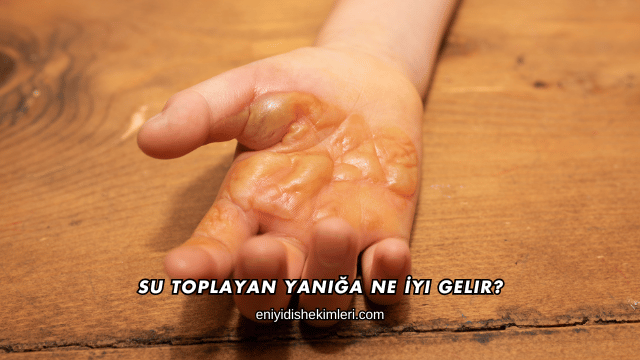 Su Toplayan Yanığa Ne İyi Gelir?