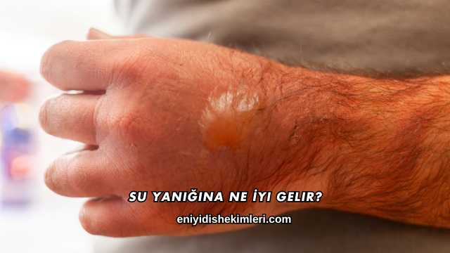 Su Yanığına Ne İyi Gelir?