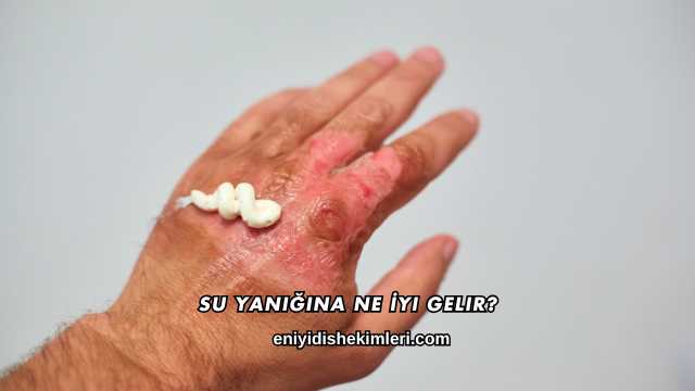 Su Yanığına Ne İyi Gelir?