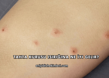 Tahta Kurusu Isırığına Ne İyi Gelir?