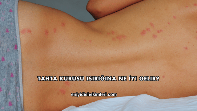 Tahta Kurusu Isırığına Ne İyi Gelir?