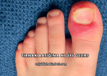 Tırnak Batığına Ne İyi Gelir?
