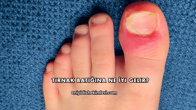 Tırnak Batığına Ne İyi Gelir?