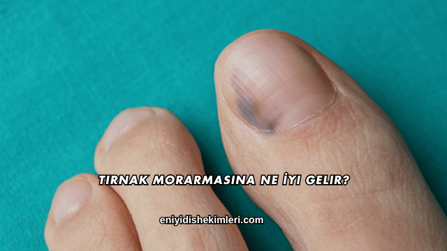 Tırnak Morarmasına Ne İyi Gelir?
