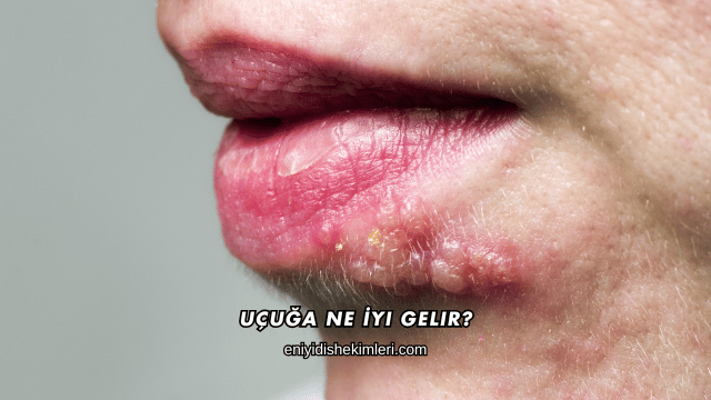 Uçuğa Ne İyi Gelir