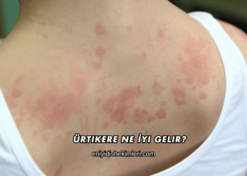 Ürtikere Ne İyi Gelir?