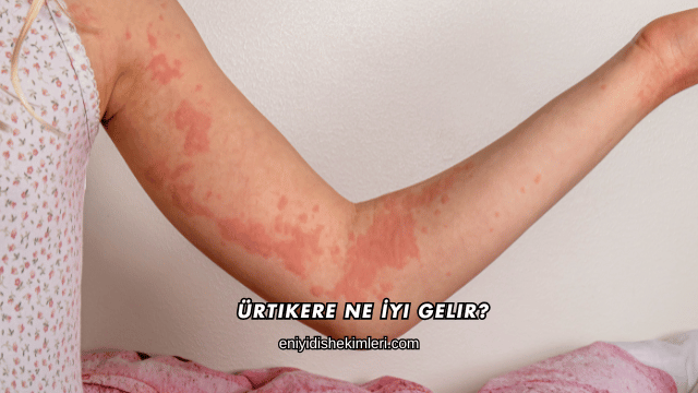 Ürtikere Ne İyi Gelir?