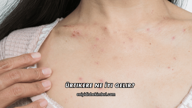 Ürtikere Ne İyi Gelir?