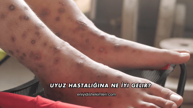 Uyuz Hastalığına Ne İyi Gelir?