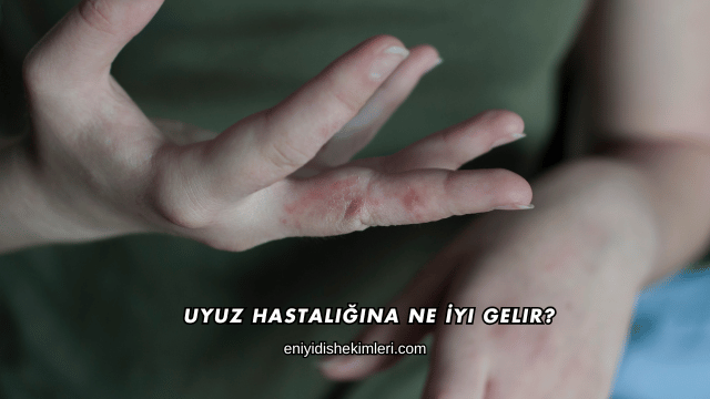 Uyuz Hastalığına Ne İyi Gelir?