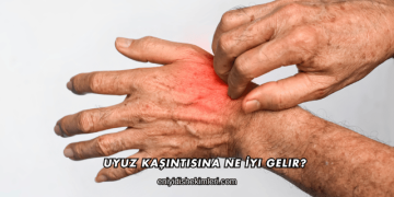 Uyuz Kaşıntısına Ne İyi Gelir?