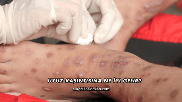 Uyuz Kaşıntısına Ne İyi Gelir?