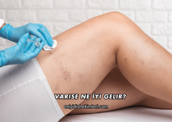 Varise Ne İyi Gelir?