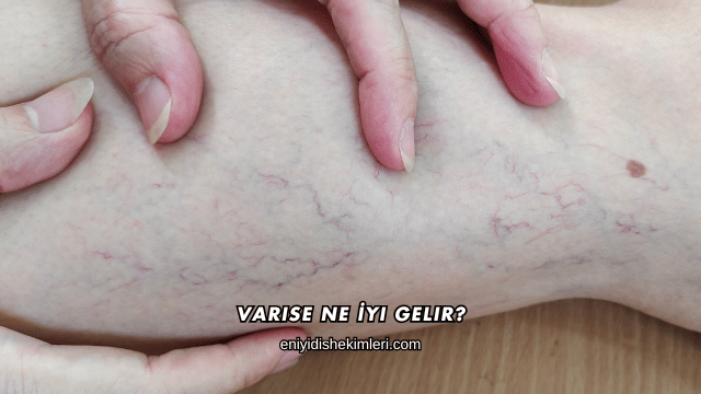 Varise Ne İyi Gelir?