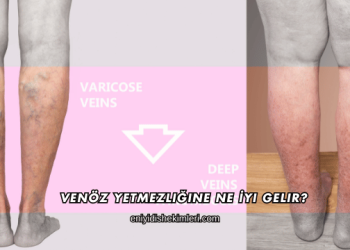 Venöz Yetmezliğine Ne İyi Gelir?