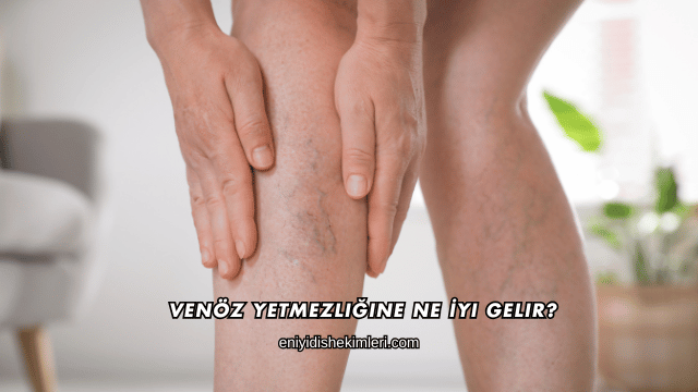 Venöz Yetmezliğine Ne İyi Gelir?
