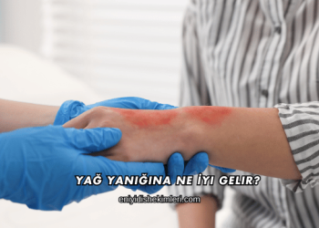 Yağ Yanığına Ne İyi Gelir?