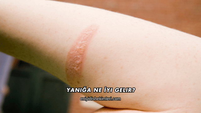 Yanığa Ne İyi Gelir?