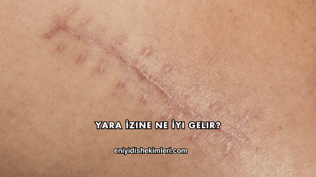 Yara İzine Ne İyi Gelir?