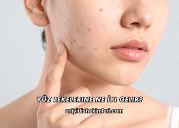Yüz Lekelerine Ne İyi Gelir?