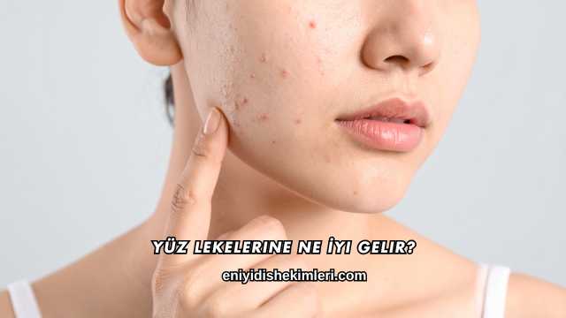 Yüz Lekelerine Ne İyi Gelir?