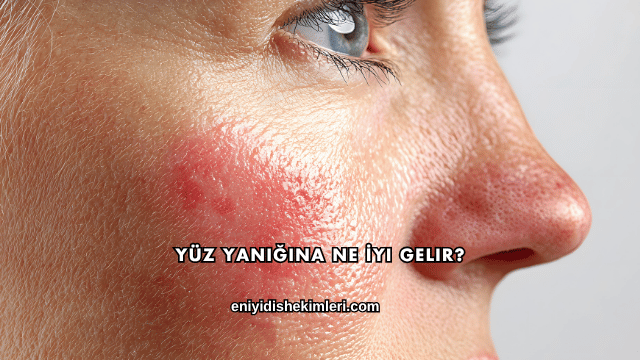 Yüz Yanığına Ne İyi Gelir?