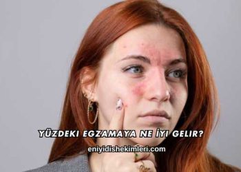 Yüzdeki Egzamaya Ne İyi Gelir?