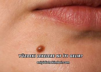 Yüzdeki Lekelere Ne İyi Gelir?