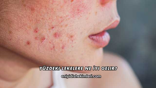 Yüzdeki Lekelere Ne İyi Gelir?