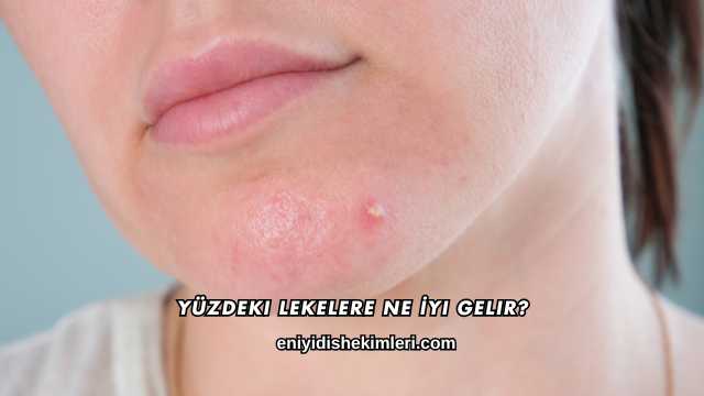 Yüzdeki Lekelere Ne İyi Gelir?