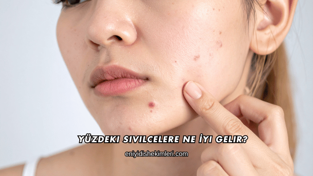 Yüzdeki Sivilcelere Ne İyi Gelir?